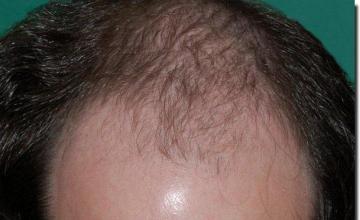 Hair restoration procedure results