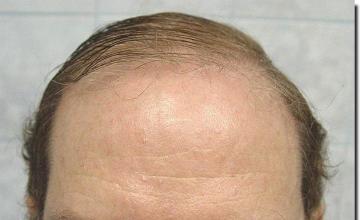 Hair restoration procedure results