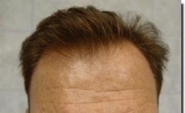 Hair restoration procedure results