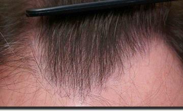 Hair restoration procedure results