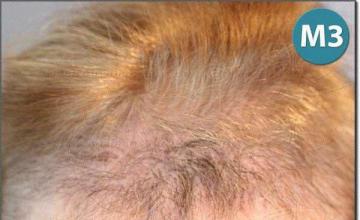 Hair restoration procedure results
