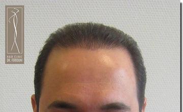 Hair restoration procedure results