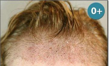 Hair restoration procedure results