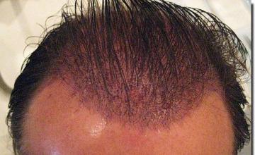 Hair restoration procedure results