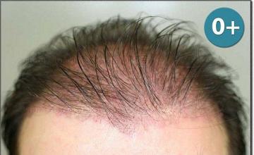Hair restoration procedure results