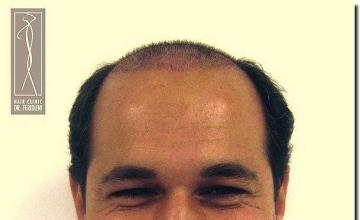 Hair restoration procedure results