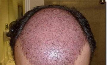 Hair restoration procedure results