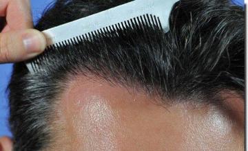 Hair restoration procedure results