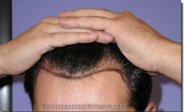 Hair restoration procedure results