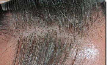 Hair restoration procedure results