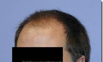 Hair restoration procedure results