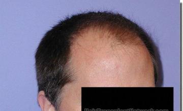 Hair restoration procedure results