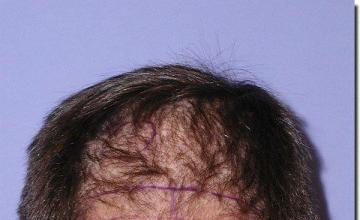 Hair restoration procedure results