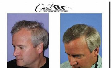 Hair restoration procedure results