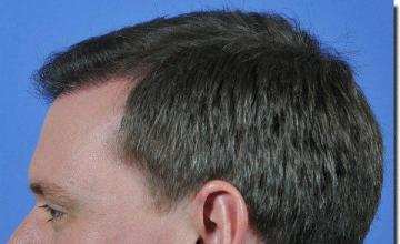 Hair restoration procedure results