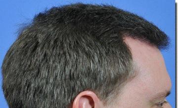 Hair restoration procedure results