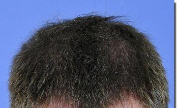 Hair restoration procedure results