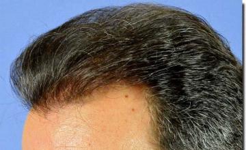 Hair restoration procedure results