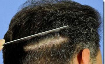 Hair restoration procedure results