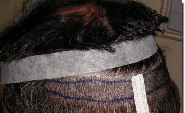 Hair restoration procedure results