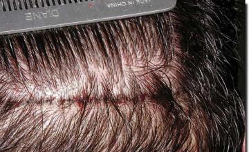 Hair restoration procedure results