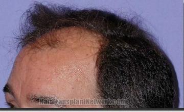 Hair restoration procedure results