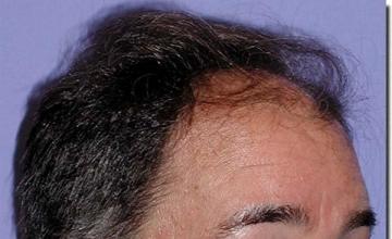 Hair restoration procedure results