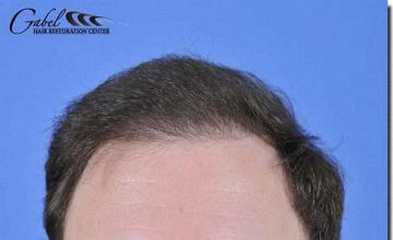 Hair restoration procedure results