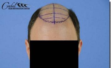 Hair restoration procedure results