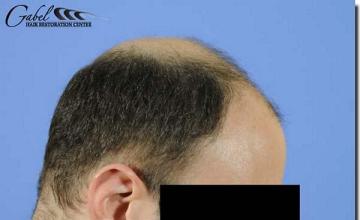 Hair restoration procedure results