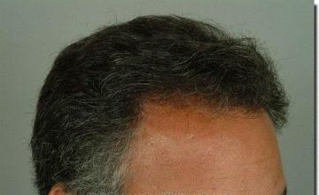 Hair restoration procedure results