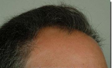 Hair restoration procedure results