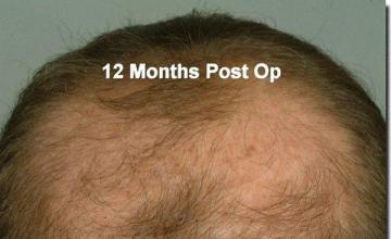 Hair restoration procedure results