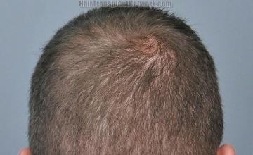 Hair restoration procedure before and after pictures