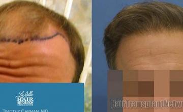 Before and after hair transplant procedure images