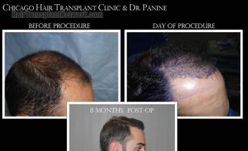 Hair transplantation surgery before and after images