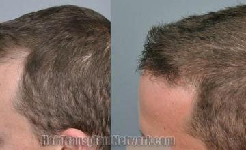 Hair transplantation surgery before and after images