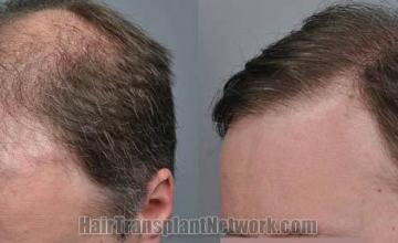 Hair transplantation surgery before and after images