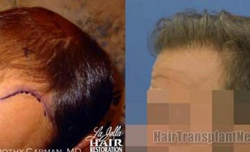 Hair transplantation surgery before and after photos