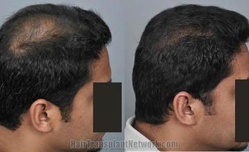 Hair transplantation surgery before and after photos