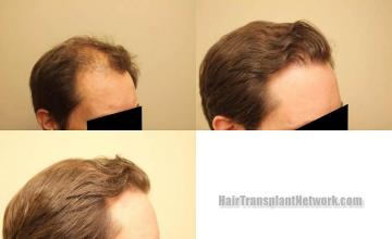 Hair transplantation surgery before and after photos