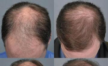 Hair transplantation surgery before and after photos