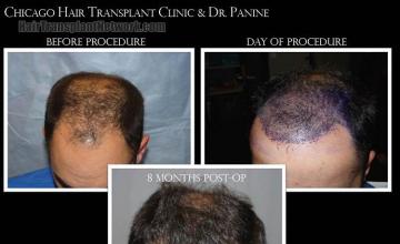 Hair transplantation surgery before and after photos