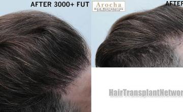 Hair transplantation surgery before and after images