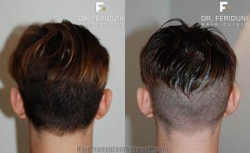 Hair transplantation surgery before and after pictures