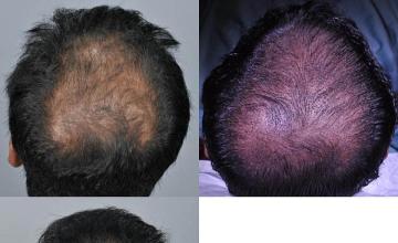 Hair transplantation surgery before and after pictures