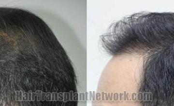 Hair transplantation surgery before and after pictures