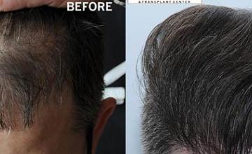 Hair transplantation surgery before and after photos