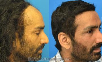 Hair transplantation surgery before and after images