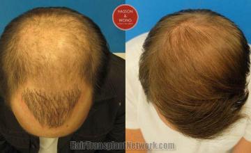 Hair transplantation surgery before and after photos